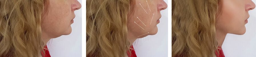 Before after kybella and filler